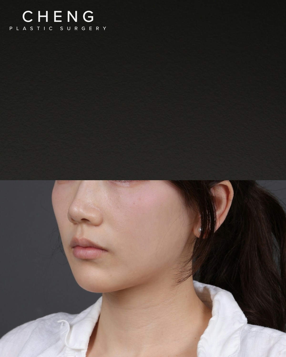 Dermal Fillers Before & After Gallery - Patient 320376 - Image 5