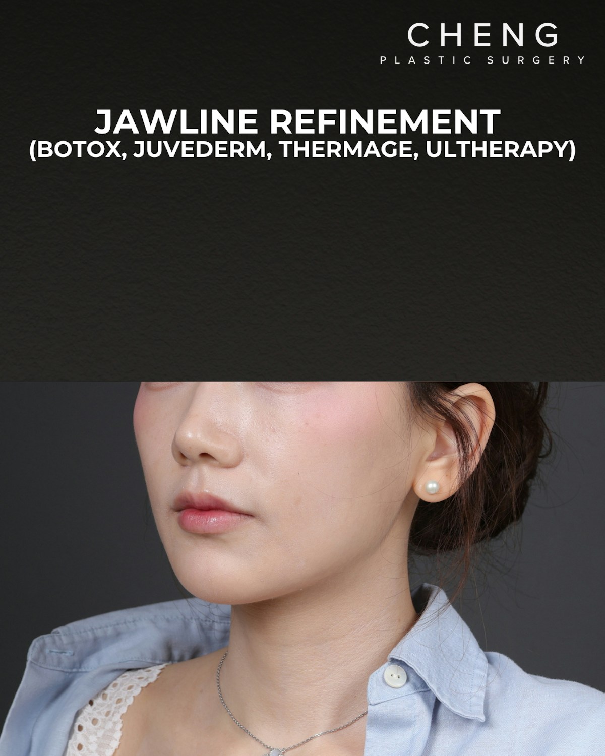 Dermal Fillers Before & After Gallery - Patient 320376 - Image 6
