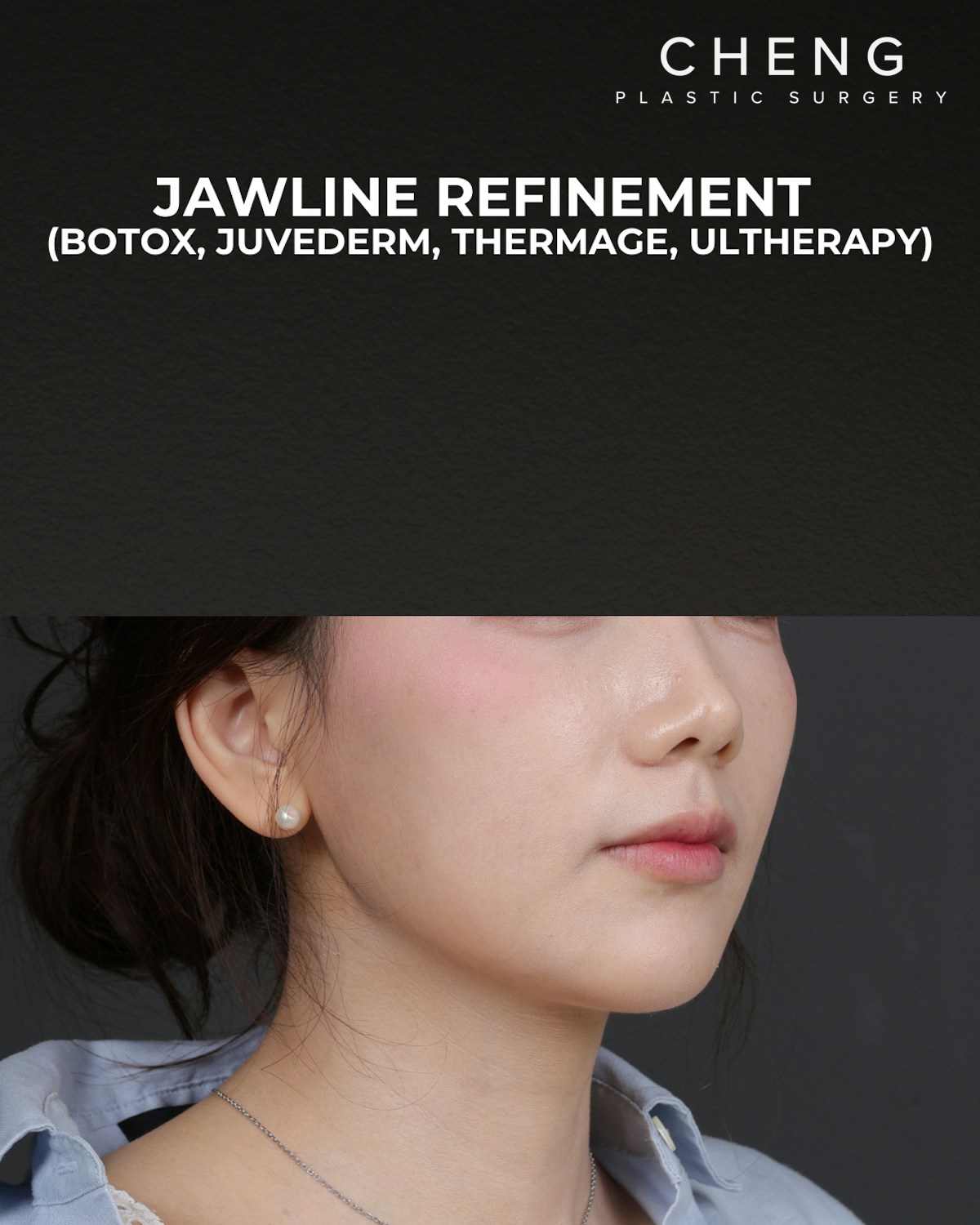 Dermal Fillers Before & After Gallery - Patient 320376 - Image 2