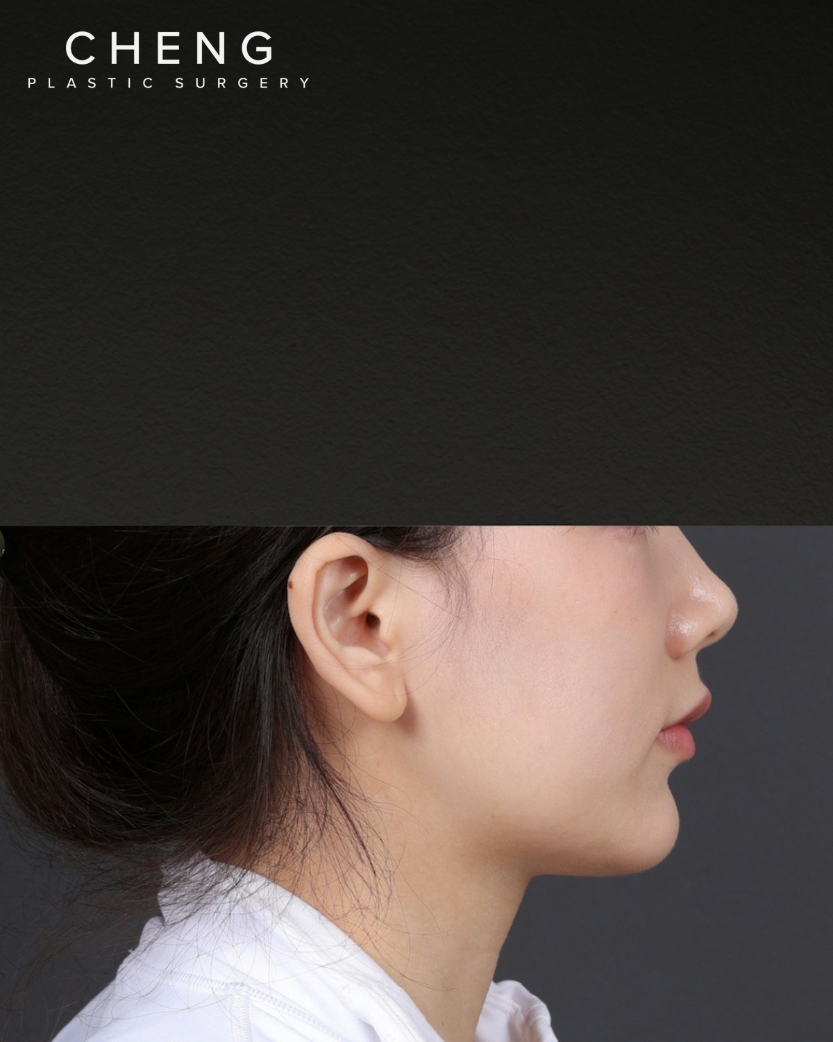 Thermage FLX Before & After Gallery - Patient 265507 - Image 3