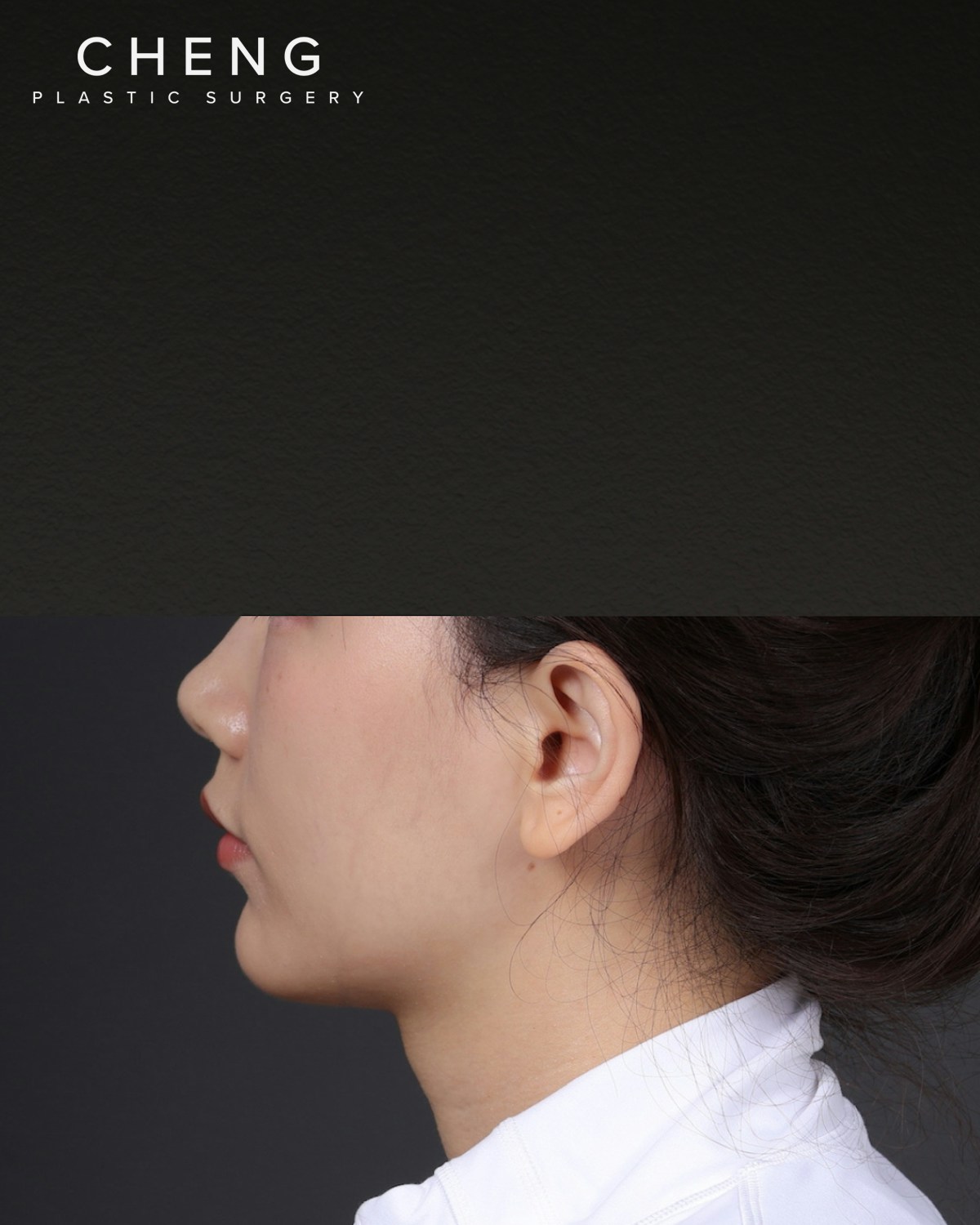 Thermage FLX Before & After Gallery - Patient 265507 - Image 7