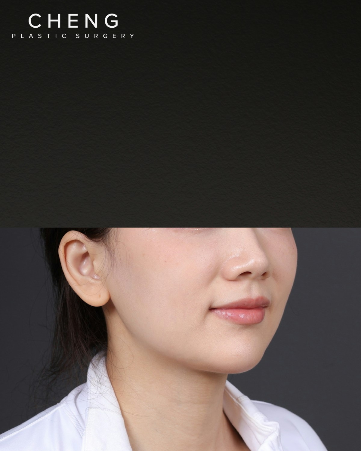 Dermal Fillers Before & After Gallery - Patient 320376 - Image 1