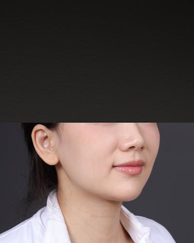 Botox and Dysport Before & After Gallery - Patient 142274 - Image 1