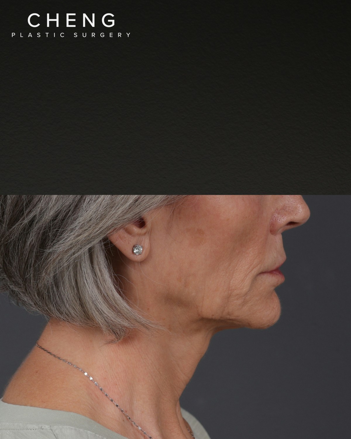 Botox and Dysport Before & After Gallery - Patient 543799 - Image 3