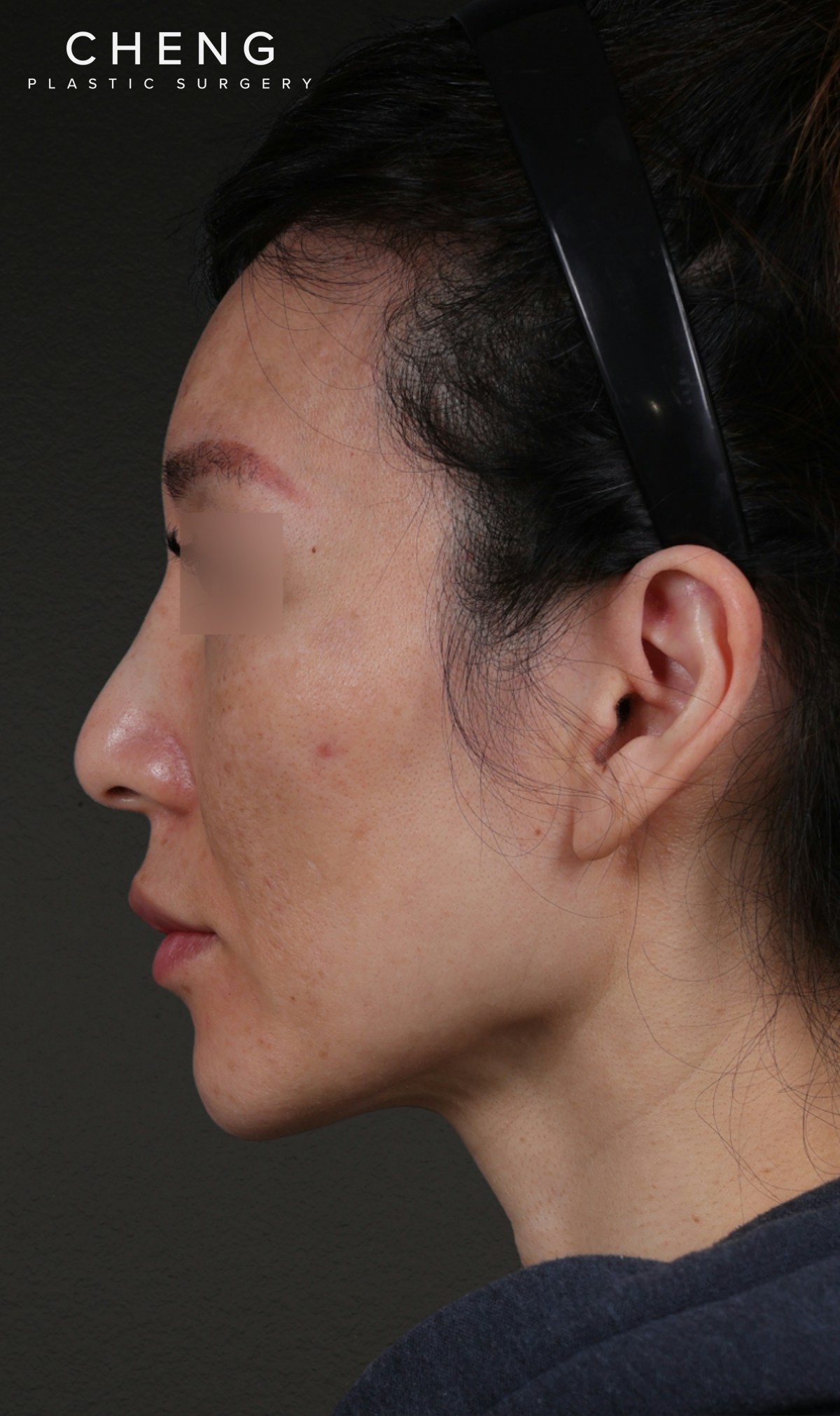 Fat Grafting Before & After Gallery - Patient 320694 - Image 9