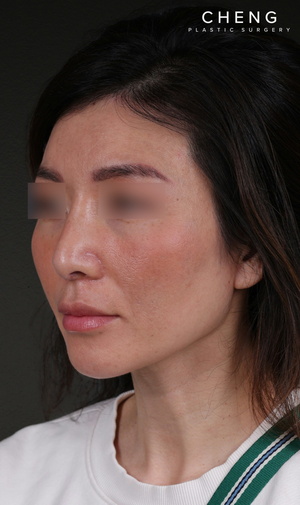 Fat Grafting Before & After Gallery - Patient 320694 - Image 8