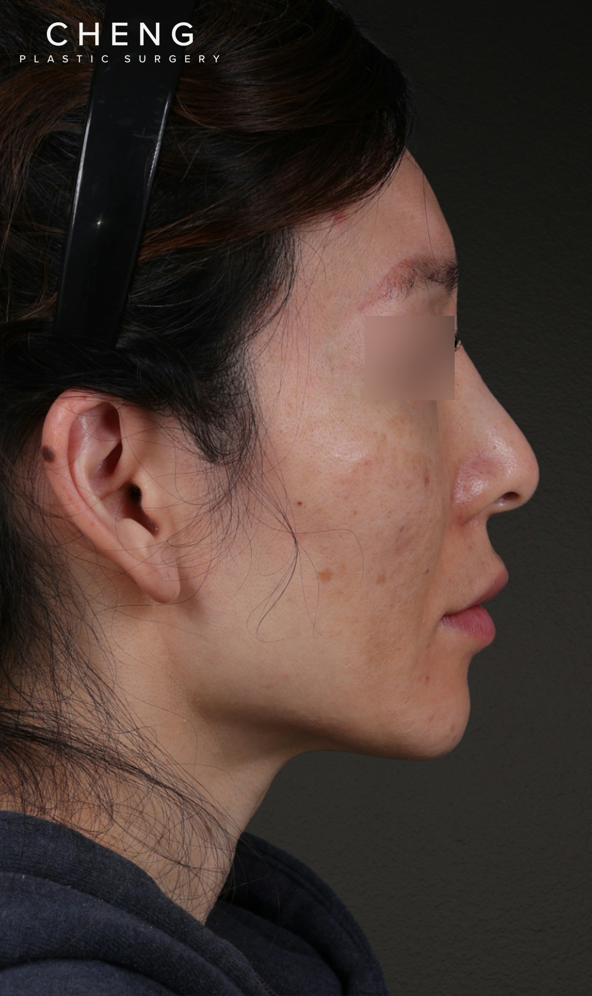 Fat Grafting Before & After Gallery - Patient 320694 - Image 5