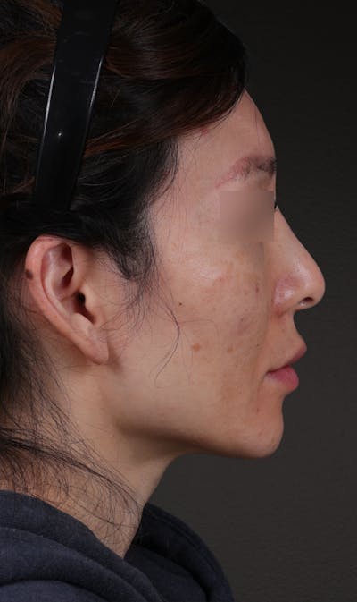 Rhinoplasty Before & After Gallery - Patient 337080 - Image 1