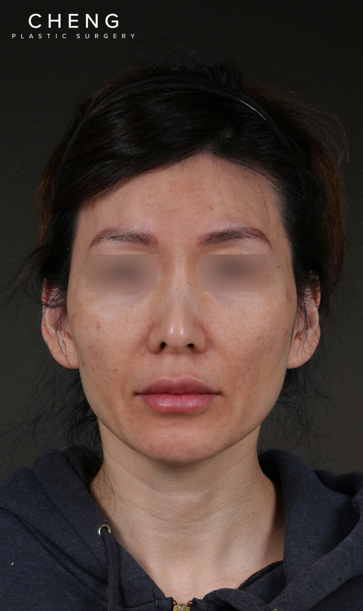 Fat Grafting Before & After Gallery - Patient 320694 - Image 1