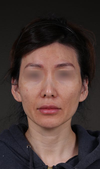 Fat Grafting Before & After Gallery - Patient 320694 - Image 1