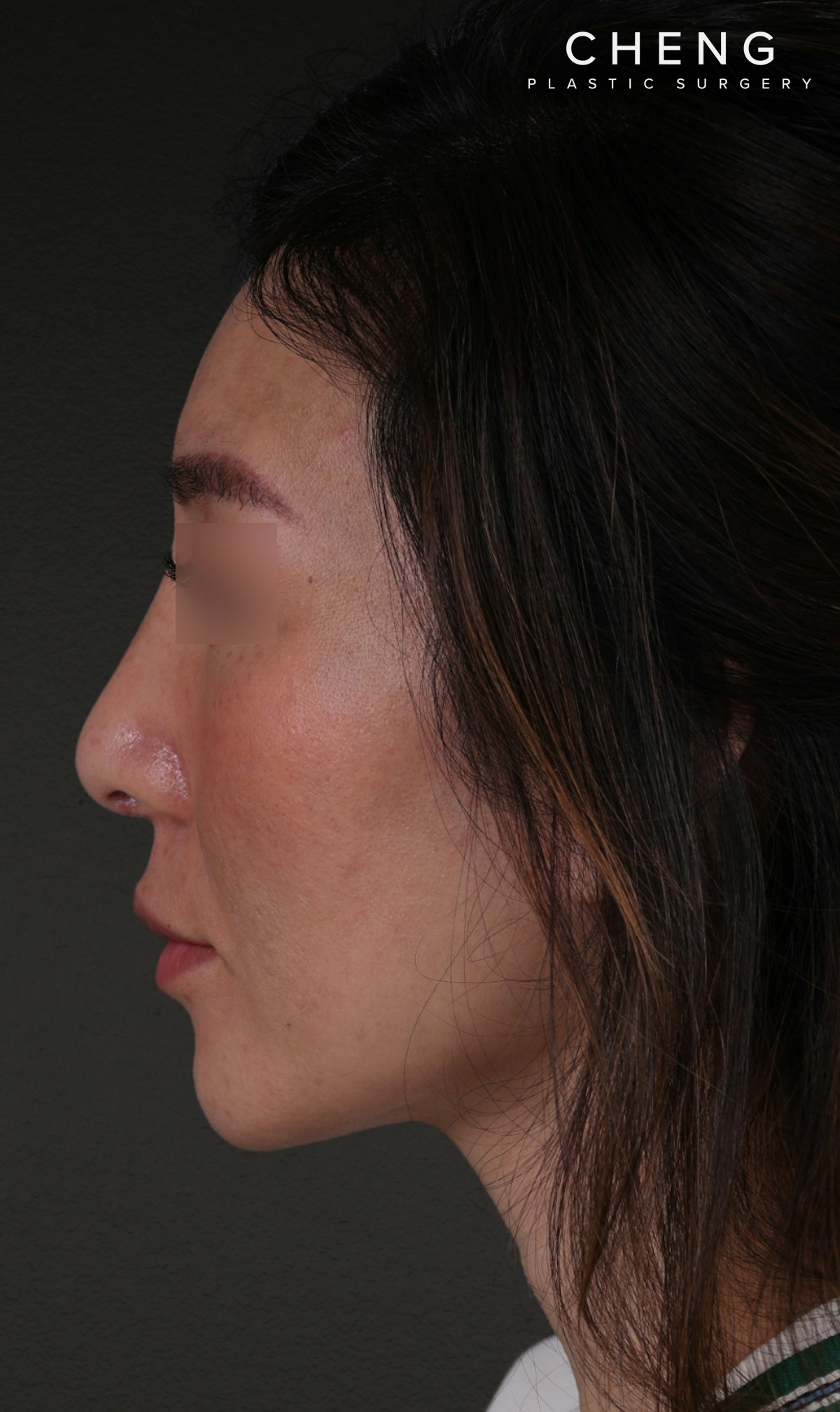 Fat Grafting Before & After Gallery - Patient 320694 - Image 10