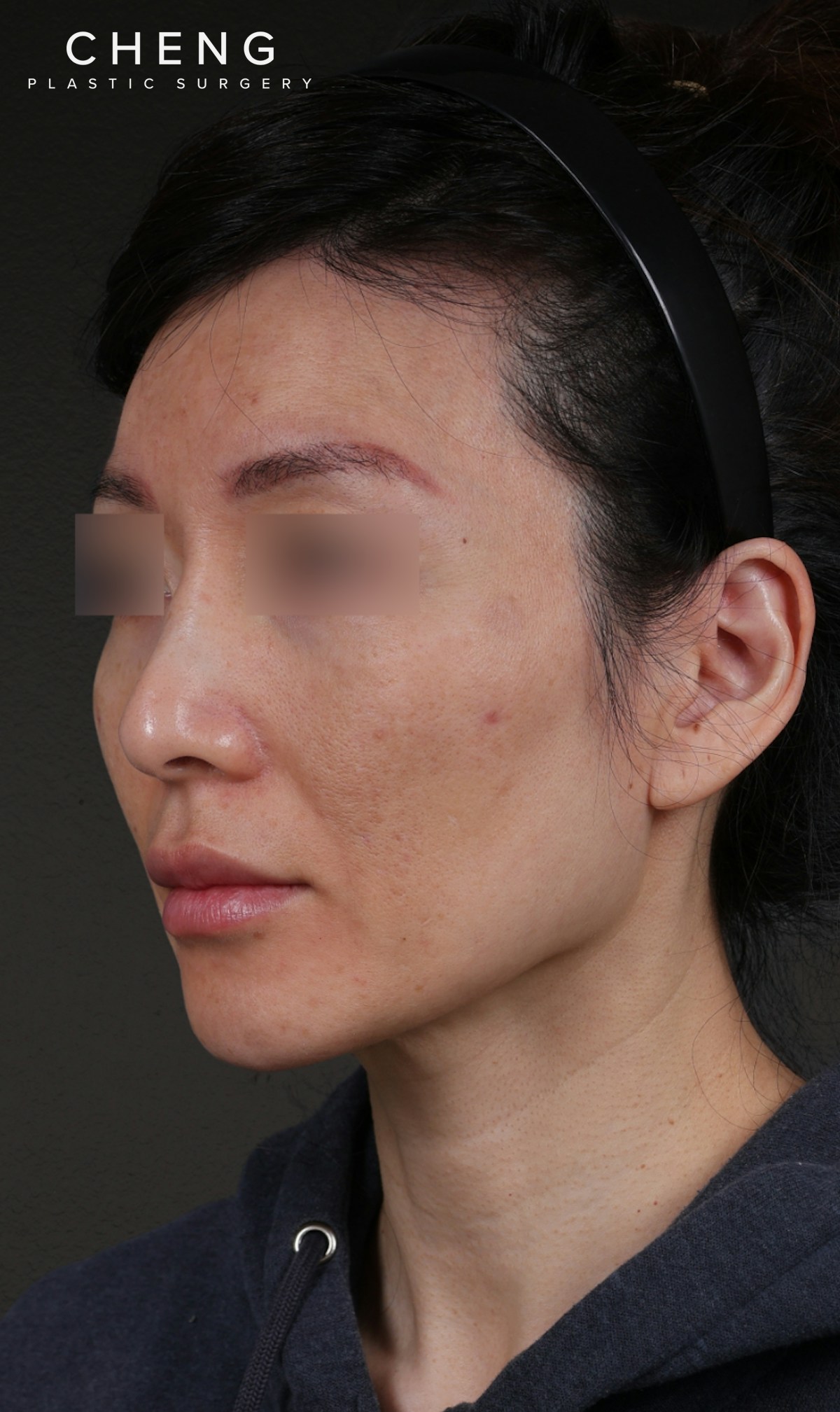 Fat Grafting Before & After Gallery - Patient 320694 - Image 7