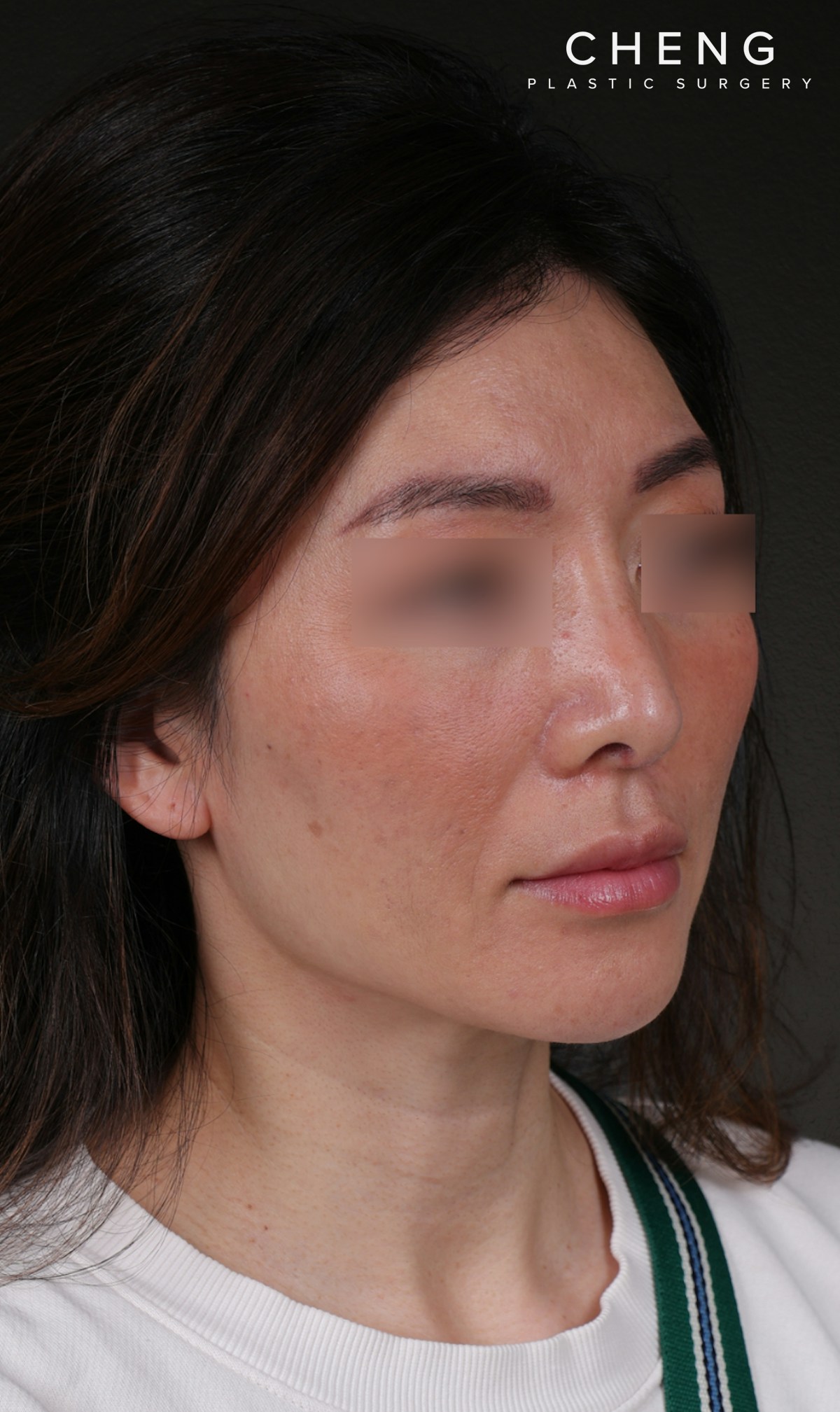 Fat Grafting Before & After Gallery - Patient 320694 - Image 4