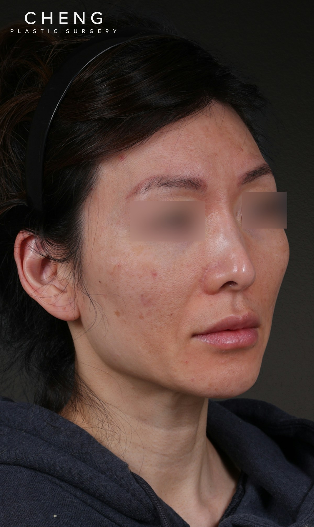 Fat Grafting Before & After Gallery - Patient 320694 - Image 3