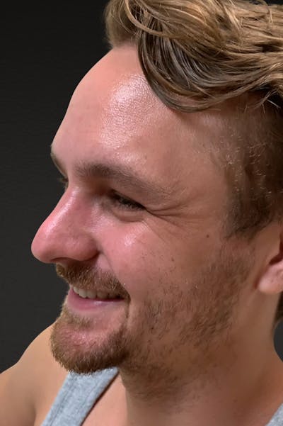 Botox and Dysport Before & After Gallery - Patient 404936 - Image 1