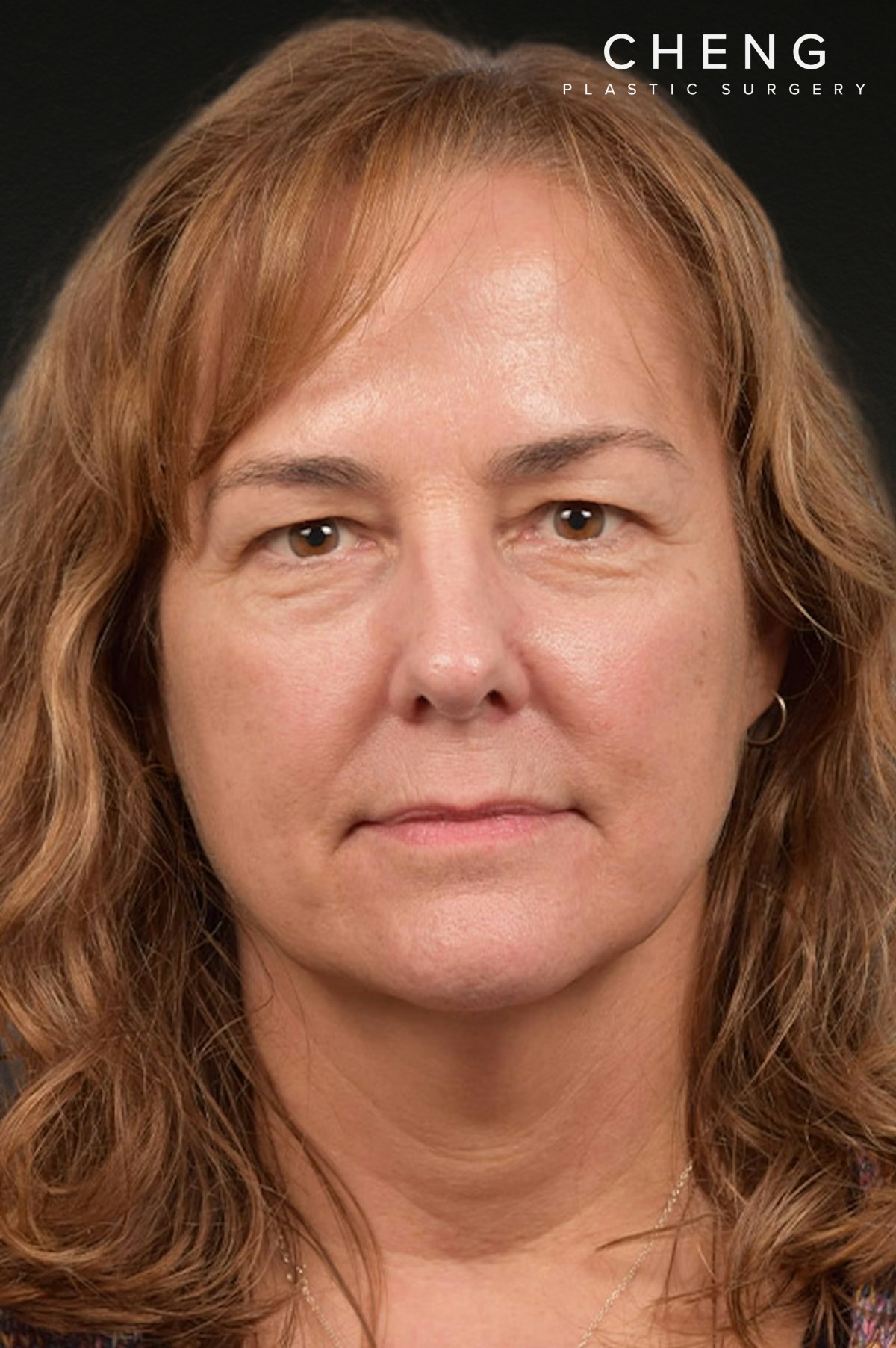 Botox and Dysport Before & After Gallery - Patient 426304 - Image 2