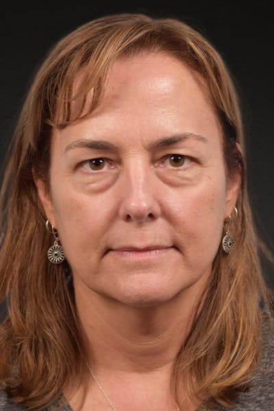 Botox and Dysport Before & After Gallery - Patient 426304 - Image 1