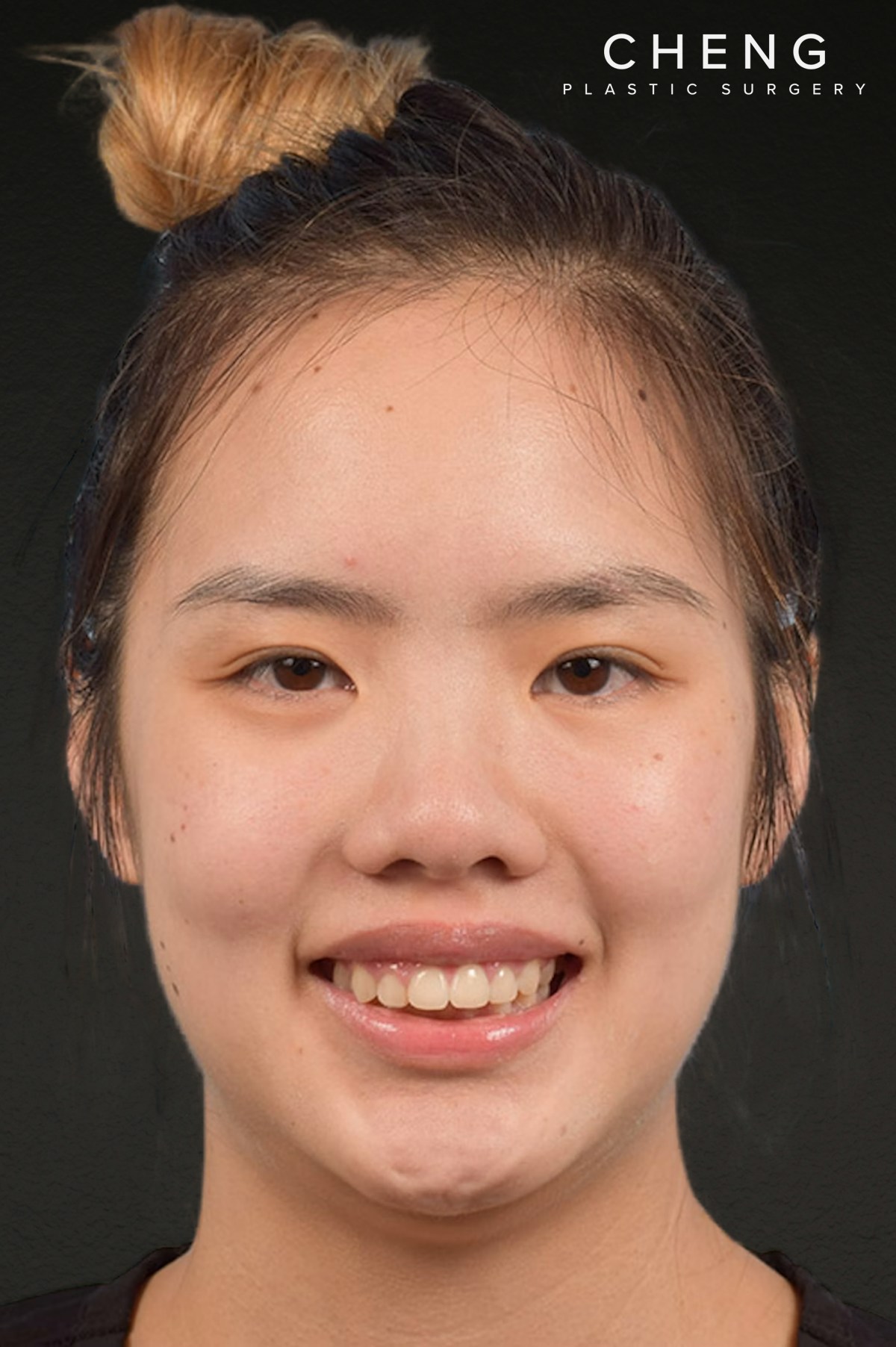 Botox and Dysport Before & After Gallery - Patient 161205 - Image 2