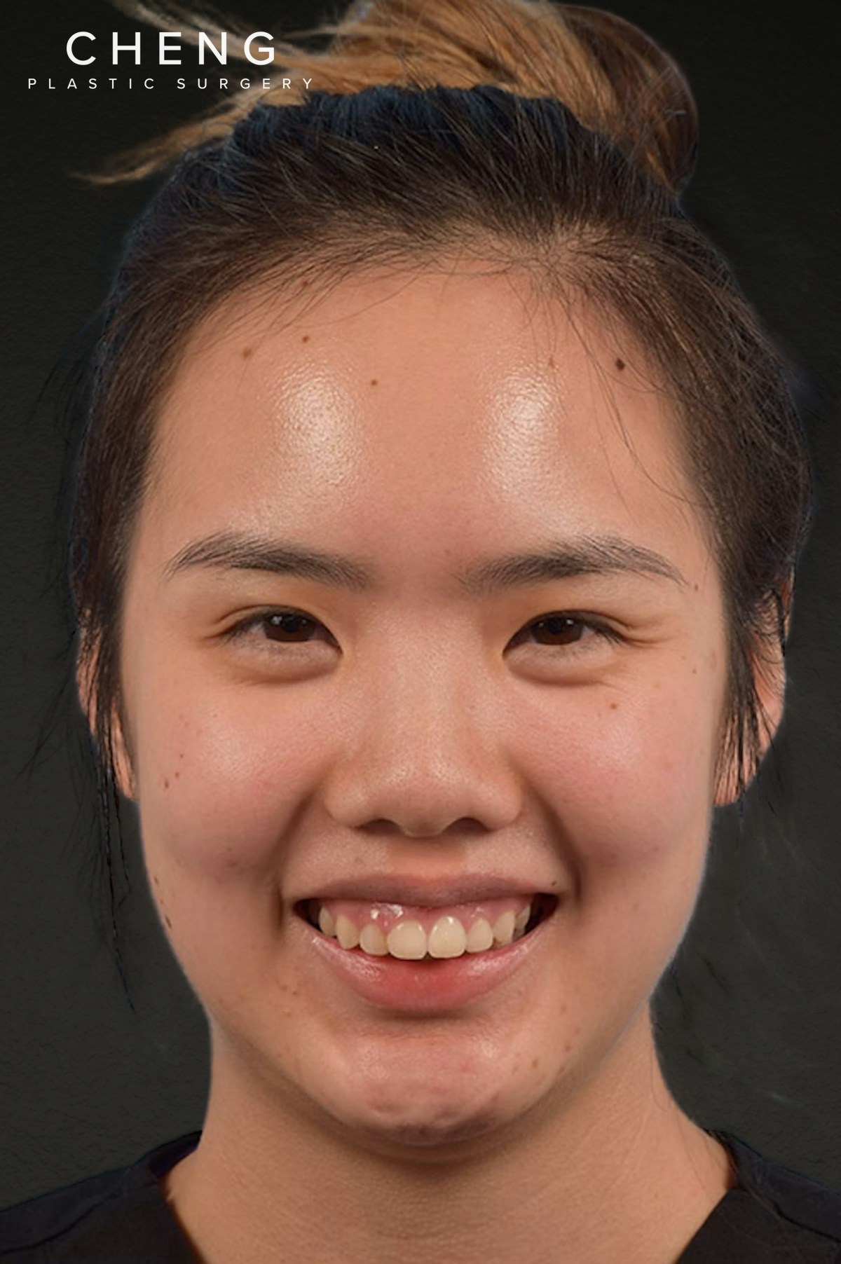 Botox and Dysport Before & After Gallery - Patient 161205 - Image 1