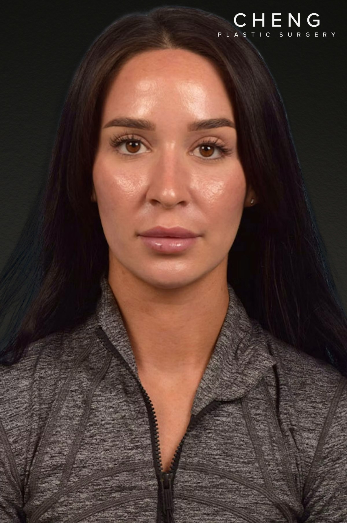 Botox and Dysport Before & After Gallery - Patient 144622 - Image 2
