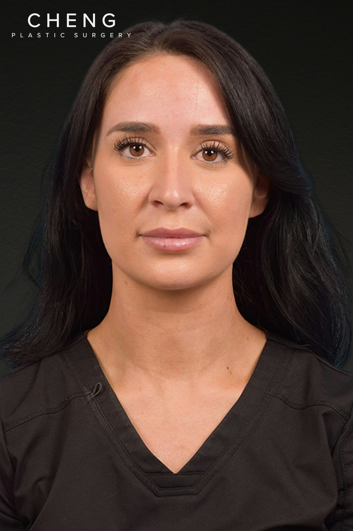Botox and Dysport Before & After Gallery - Patient 144622 - Image 1