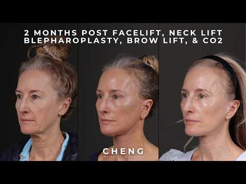 2 Months Post-Op: Her Facial Rejuvenation Journey & Honest Review | Patient Journey Pt. 4
