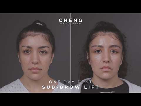 AWAKE During Surgery | Sub-Brow Lift Journey