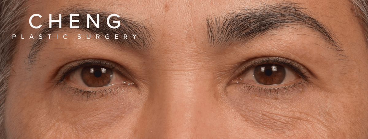Blepharoplasty Before & After Gallery - Patient 107482 - Image 1