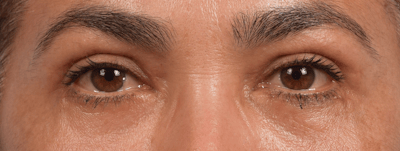 Blepharoplasty Before & After Gallery - Patient 107482 - Image 2