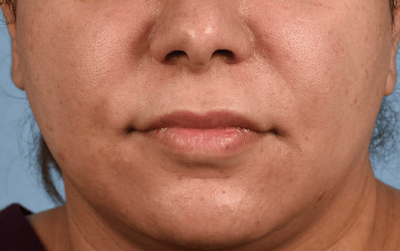 Hidden Patients Before & After Gallery - Patient 279952 - Image 1