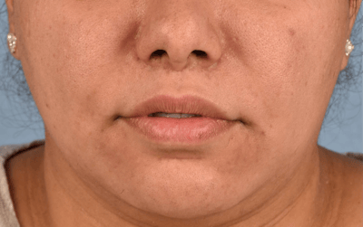 Hidden Patients Before & After Gallery - Patient 279952 - Image 2