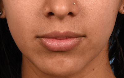 Hidden Patients Before & After Gallery - Patient 363876 - Image 2