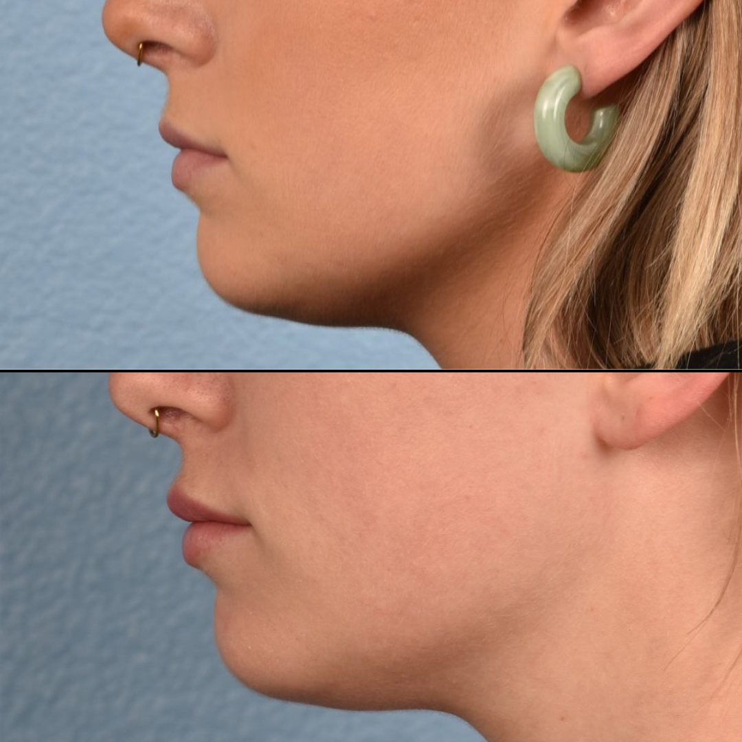 before and after
