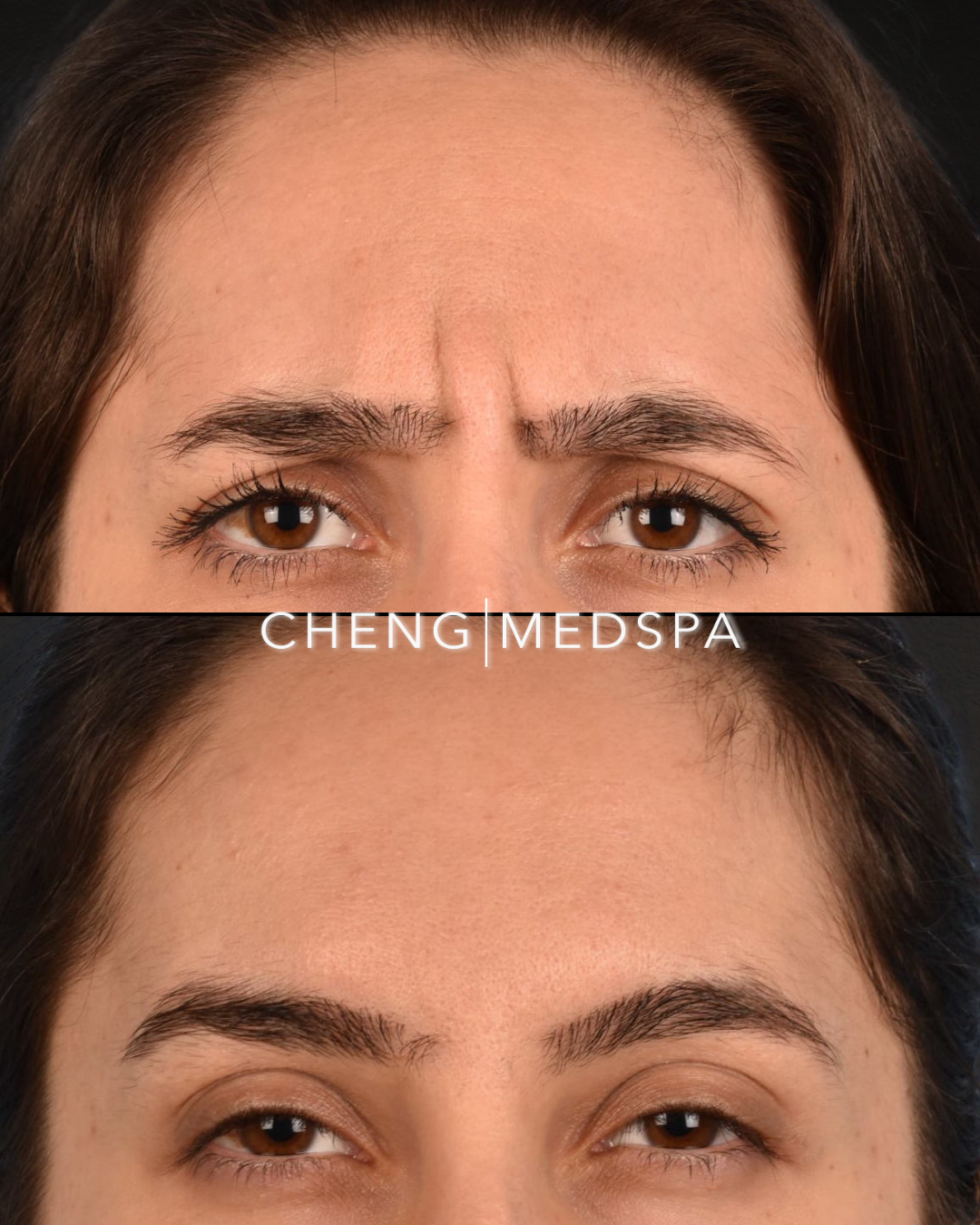 BOTOX patient results