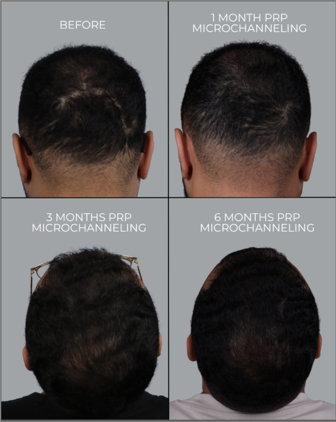 before and after