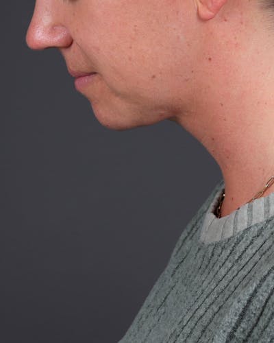 Neck Lift Before & After Gallery - Patient 261911 - Image 2